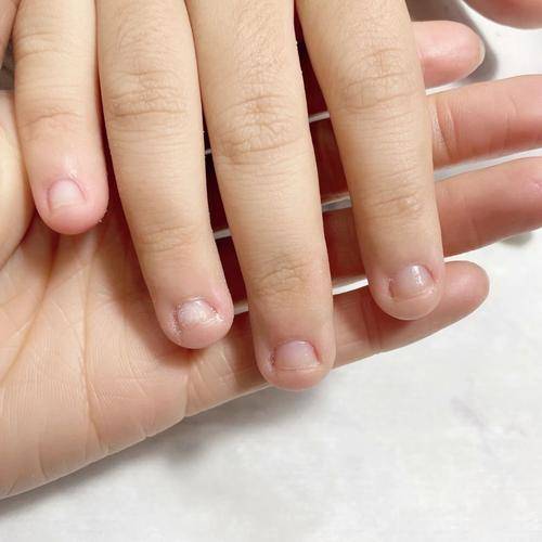 灰指甲会不会传染别人