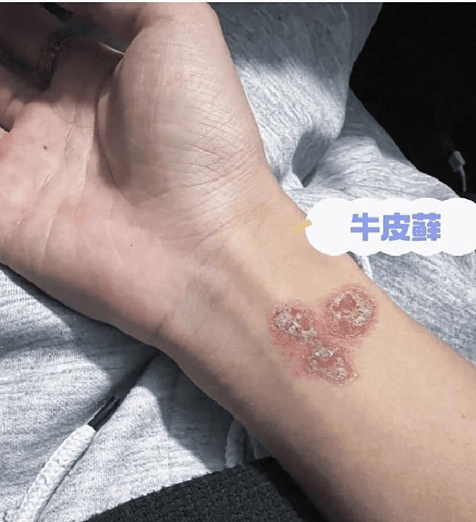银屑病不可怕！找对方法护理，皮肤会慢慢光滑