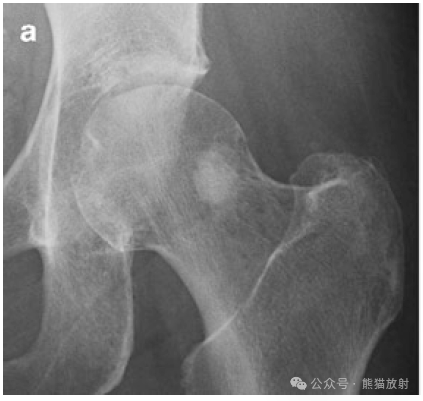 股骨颈的圆形硬化性病变，很典型