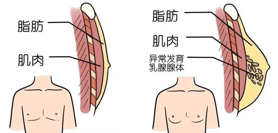 男性乳腺体发育：多数情况下的良性的