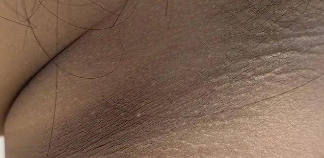 孩子脖子黑、搓不掉？当心是“黑棘皮症”！