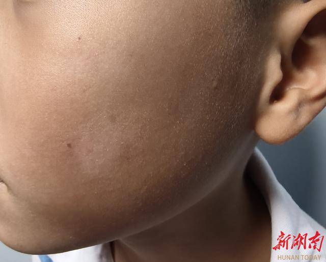 暑期接诊超千例！孩子长白斑别慌，多数不是白癜风