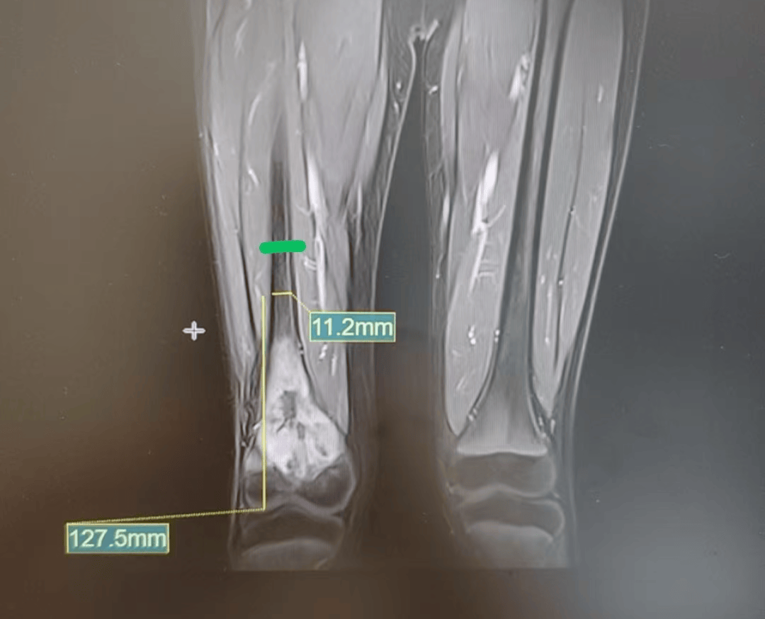膝盖疼痛2个多月，11岁男孩确诊骨癌…