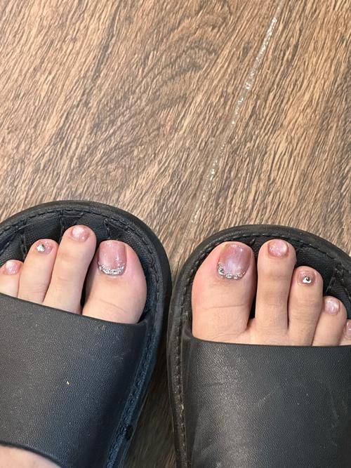 增厚型灰指甲如何根治