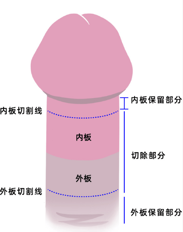 精索静脉曲张有征兆？这 3 个身体表现别忽视