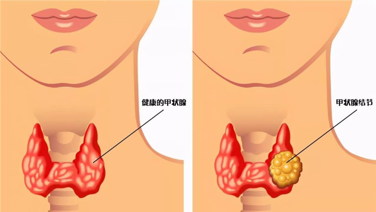 甲状腺结节会变成癌吗？这些 “特征” 才需要警惕