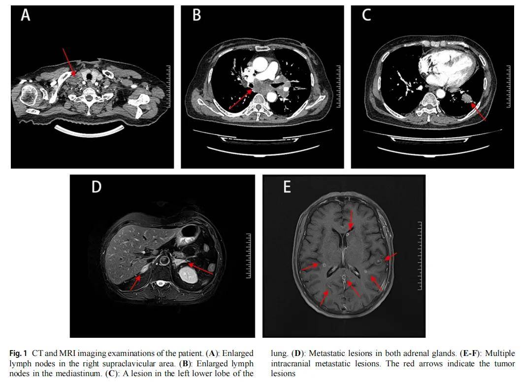 EGFR G719A/L833V共突变肺腺癌患者获益伏美替尼，持续缓解超一年