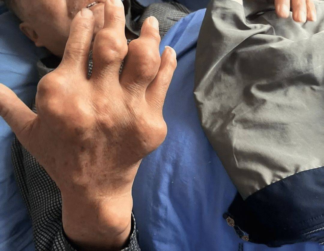 尿酸多少，痛风结节会转移？三步溶，痛风专家周桂兰答疑解惑！