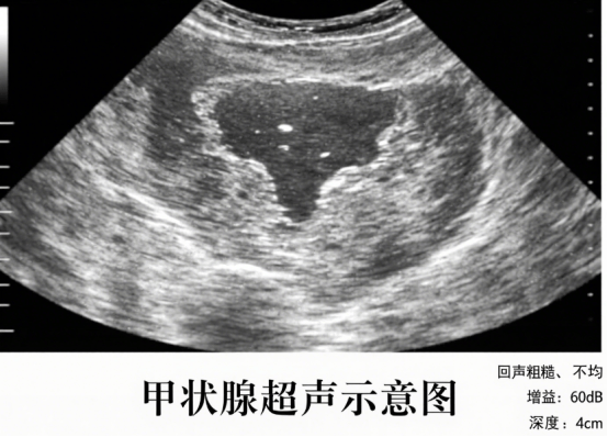 甲状腺弥漫性病变，不必闻之色变