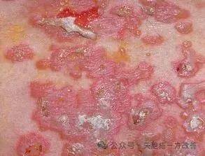 天疱疮属湿毒内蕴，健脾祛湿见奇功