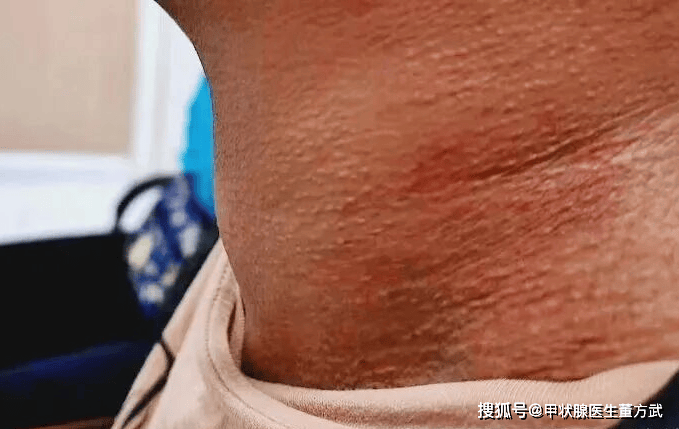 体检发现甲状腺结节，为何医生反复强调“定期复查”？