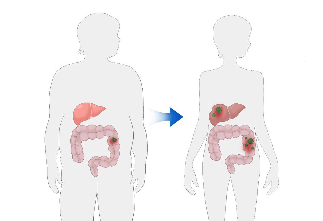 女子减肥3个月狂甩40斤，并非减肥成功，竟是确诊肠道肿瘤伴肝转移