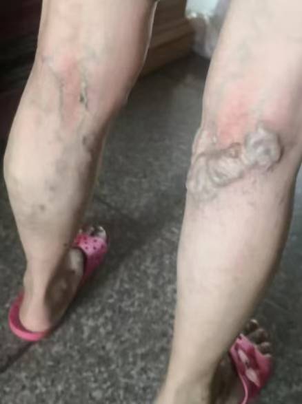 杨希亭院长谈静脉曲张的危害和治疗