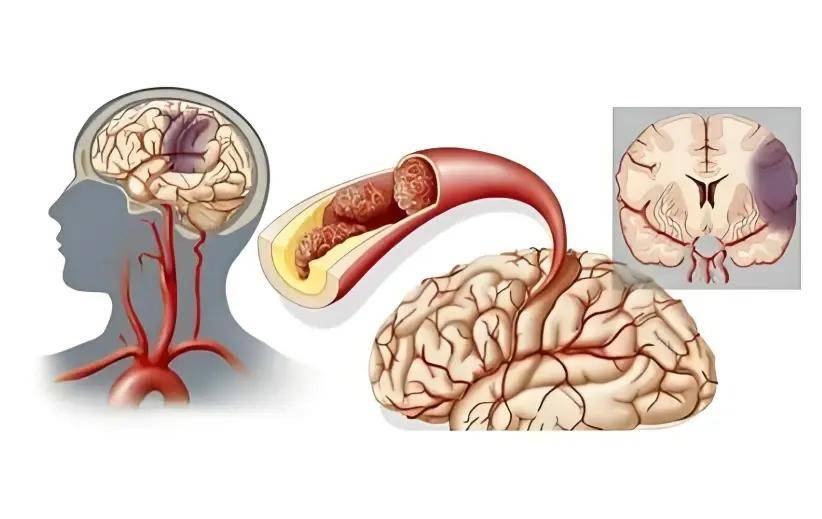 史常梅医生：人人怕脑梗，它却怕你做4件事！