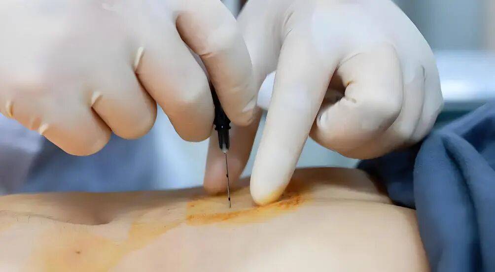 穴位埋线：一种不止于减肥的中医调理法