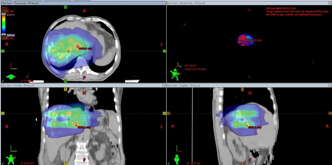 “国际”力量｜勇闯“禁区”！放疗科团队创新应用晶格放疗，破解巨大晚期肝癌伴癌栓治疗困局