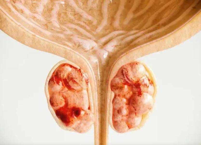 原创            前列腺癌多是“拖出来”的？提醒：出现这4个症状，男性要多警惕