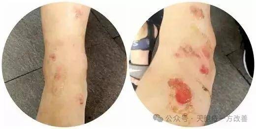 天疱疮：一剂健脾祛湿，十日敛疮生肌！