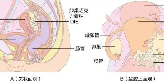 子宫内膜异位症相关疼痛