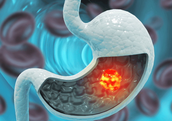 青榴互联网医院左兴旺：不良饮食习惯导致胃癌的因素有哪些？