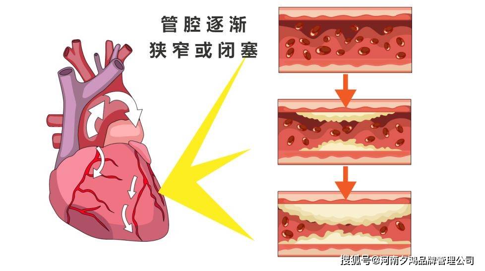 冠心病全方位指南：从识别信号到科学防治