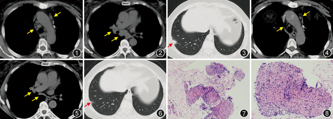 【病例报告】肺腺癌根治术后合并自愈的肺结节病1例