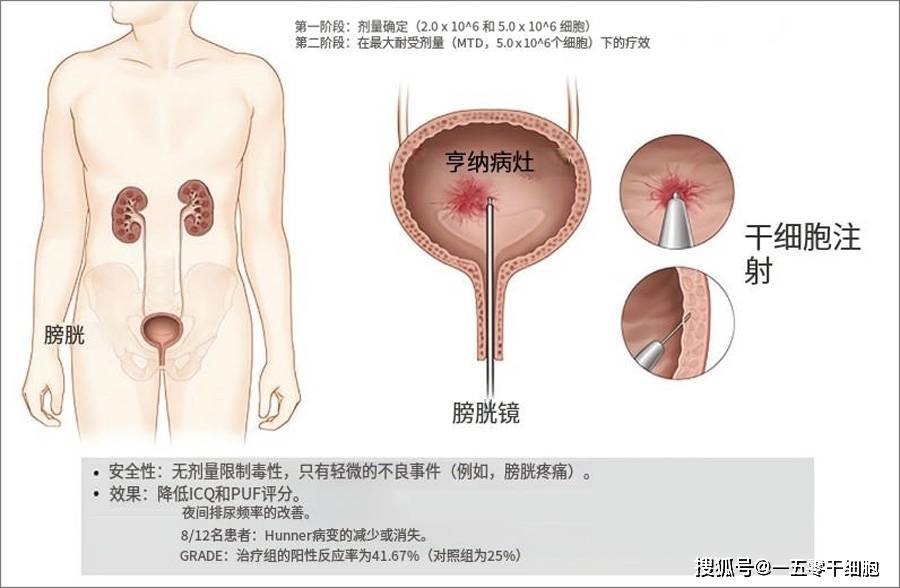 原创            干细胞治疗间质性膀胱炎6个月：67%患者病灶缩小/完全消失