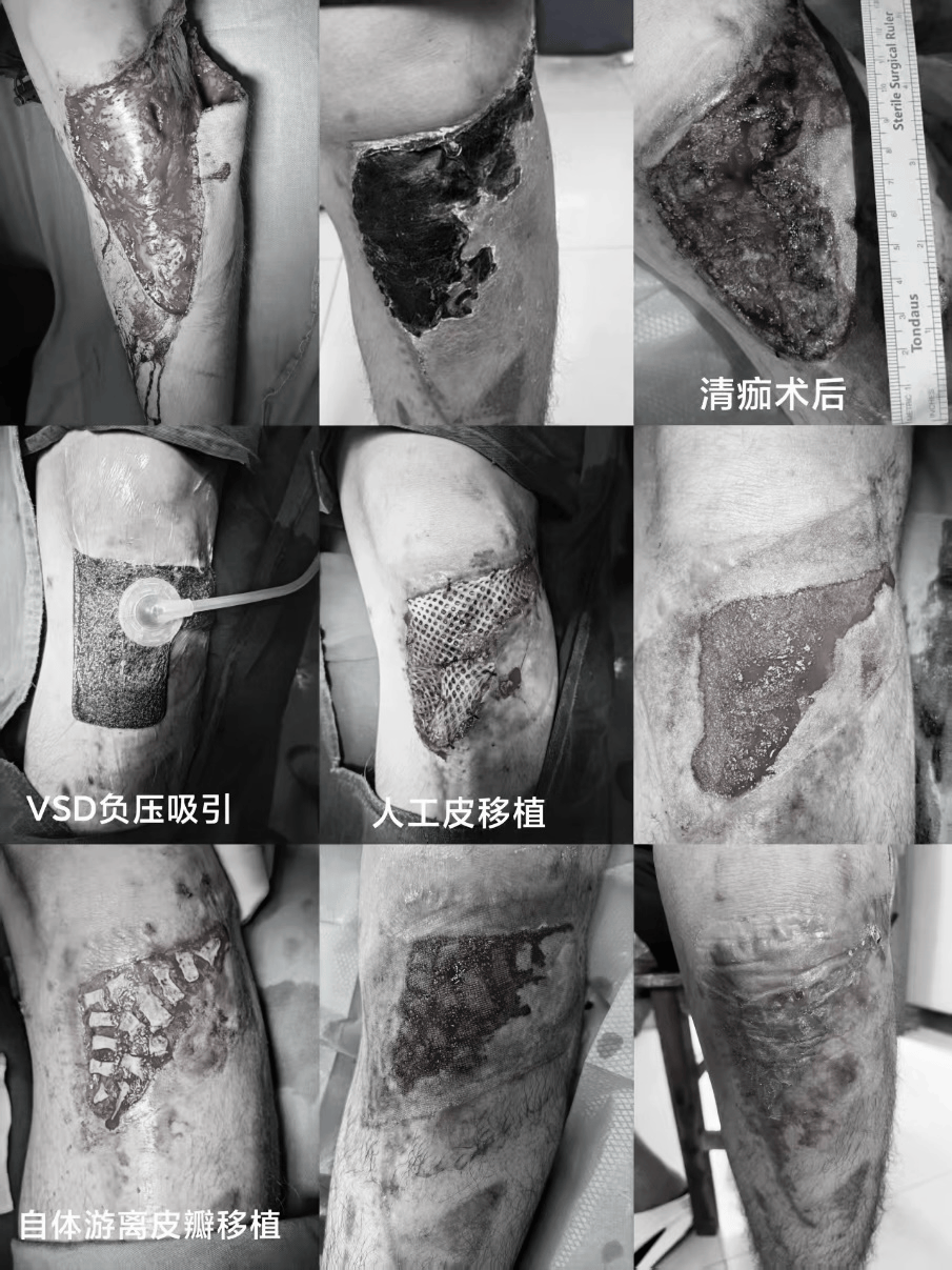 破解慢性创面难题：定远县总院美容整形科诊疗方案与康复实践