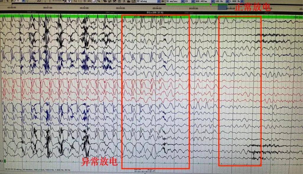 为何孩子总发呆走神，警惕“小儿失神性癫痫”