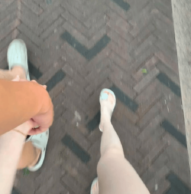 牛皮癣困扰3年终见光滑肌肤！