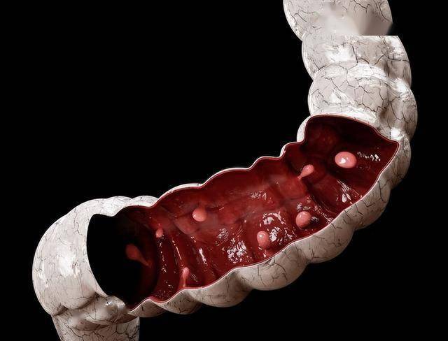 八成肠癌是息肉变的，肠子里长息肉的三个表现，很多人都忽略了