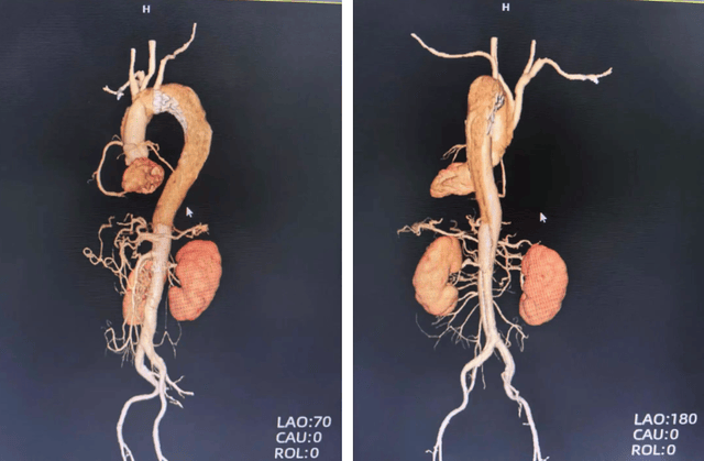 男子孤身出差突发A型主动脉夹层！医生携手紧急救治助其转危为安