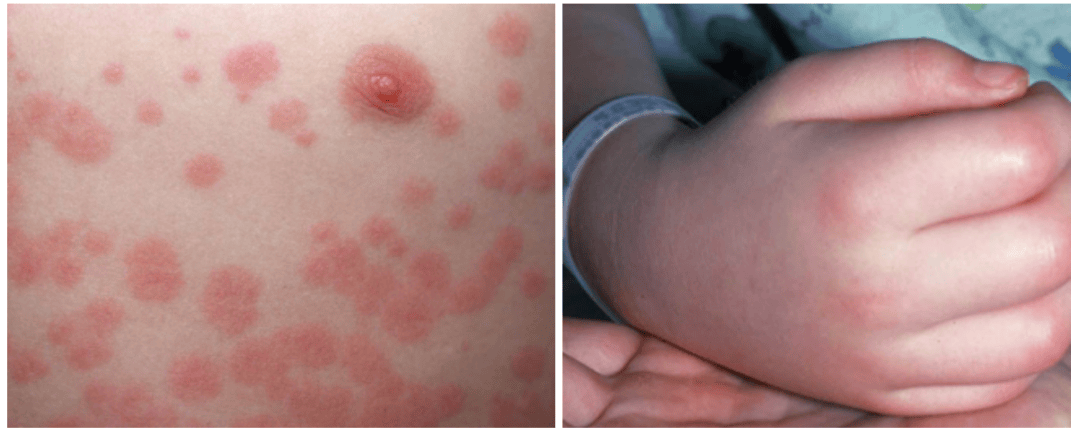 孩子得了川崎病会有哪些症状？该怎么办？