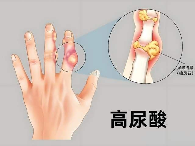 原创            尿酸没控制好？小心高尿酸血症，这些习惯最易中招，早干预是关键