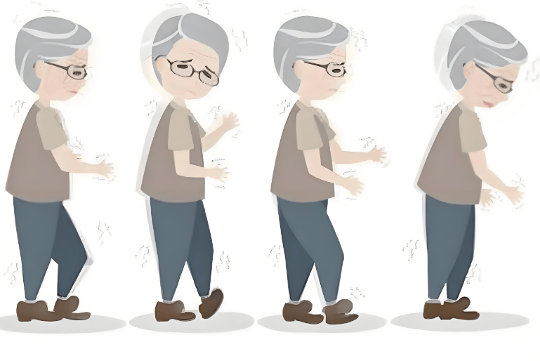 帕金森病，步态先知？医生提醒：走路出现这几种变化，可能是身体最早期的警报！
