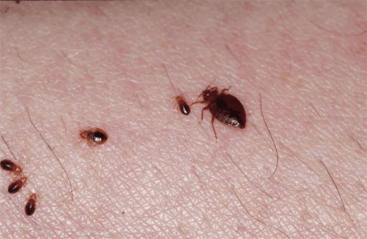 多人被咬，身上出现不明红包，当心是床虱！