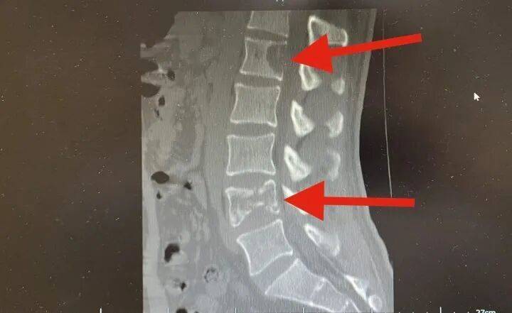 28岁奶爸腰痛半年，一查竟是肺癌晚期，开始没在意，以为是抱孩子累的