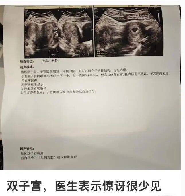 “本次怀孕在左侧！”双子宫孕妈发文引发热议！医生：少见但不罕见，多数不需干预