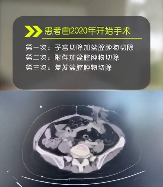 五年4次手术，肿瘤依旧复发！差点放弃的她，在这里重生！