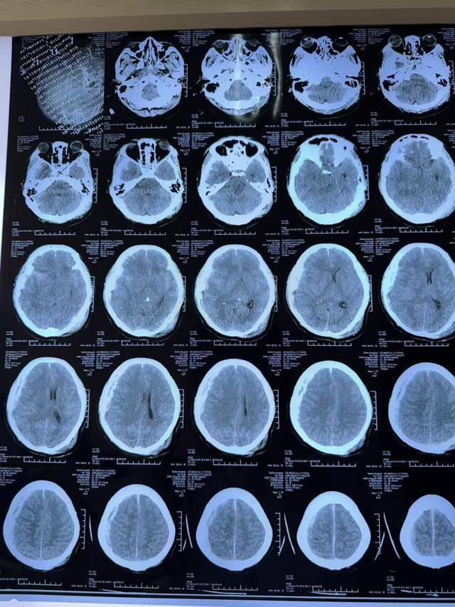 42岁男子命悬一线！泰和医院开颅“拆弹”，创造生命奇迹