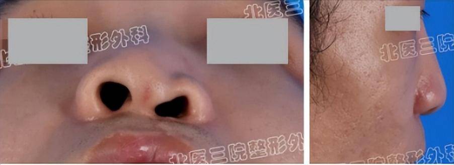 唇裂鼻修复：巧用鼻内“支柱”骨+多学科协作