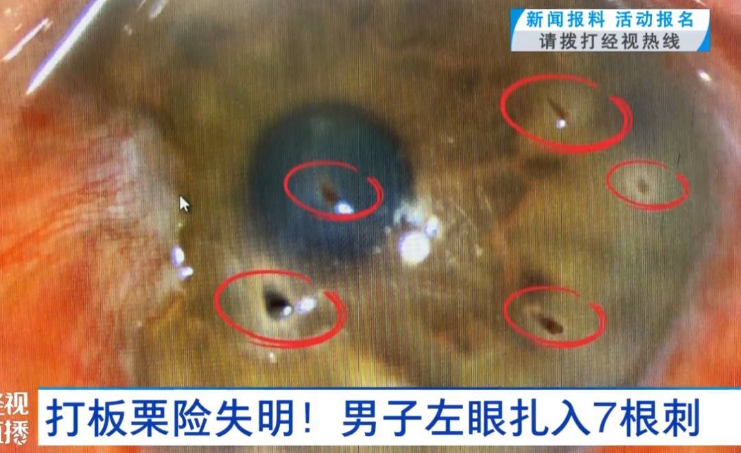 吓人！一男子左眼扎入7根刺，险失明！医生：每年9月高发