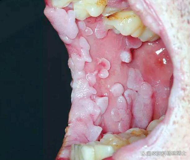 口腔HPV感染：症状与治疗全解析