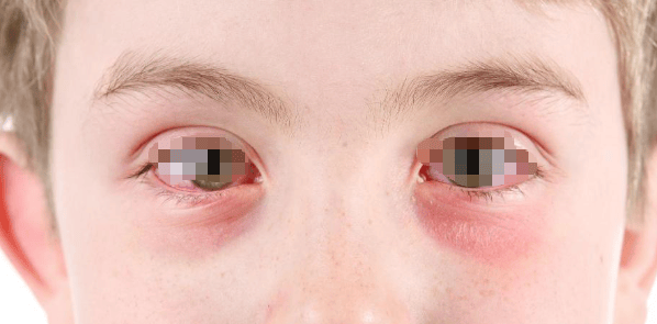 结膜炎反复难愈？中医：找准诱因，3 招可调理