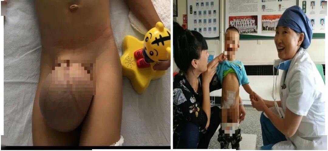 【朝医新闻】时隔八年，普外中心疝和腹壁外科再次为患儿成功实施复杂疝手术