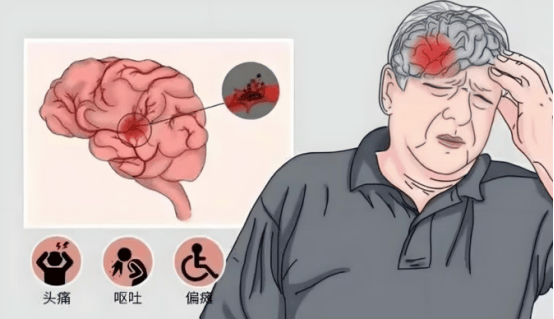 黄力医生：为什么，心梗脑梗越来越年轻化？这三个习惯是元凶