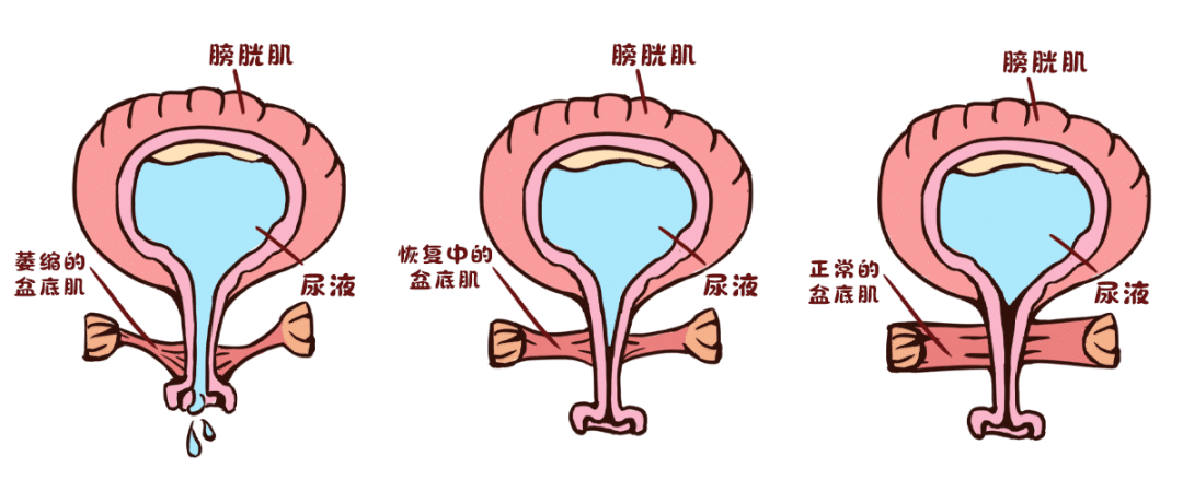 告别尴尬，重获掌控：盆底肌锻炼全攻略与“窍门”妙用