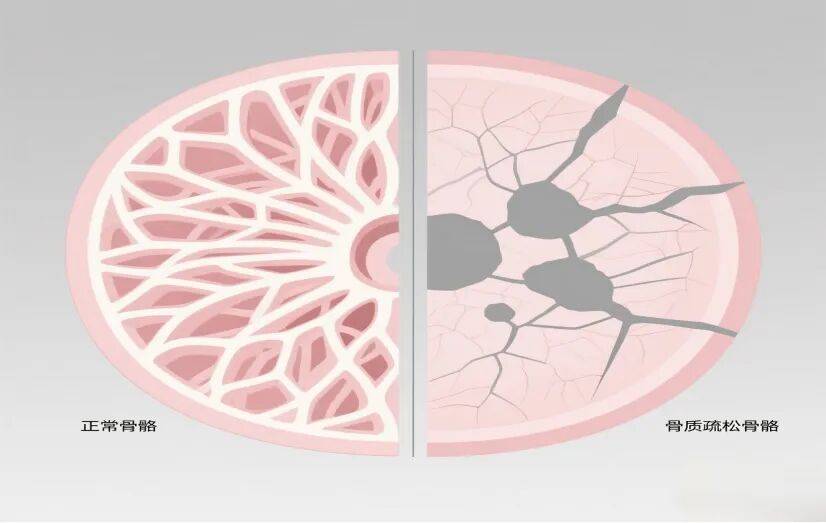沉默的杀手：骨质疏松症