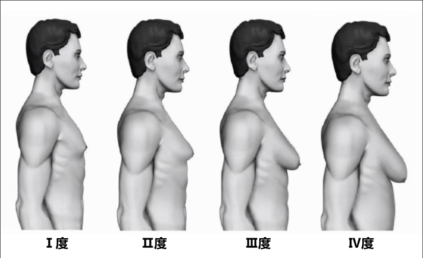 四川医生分享案例|依非韦伦致艾滋患者出现Ⅲ度男性乳房发育症