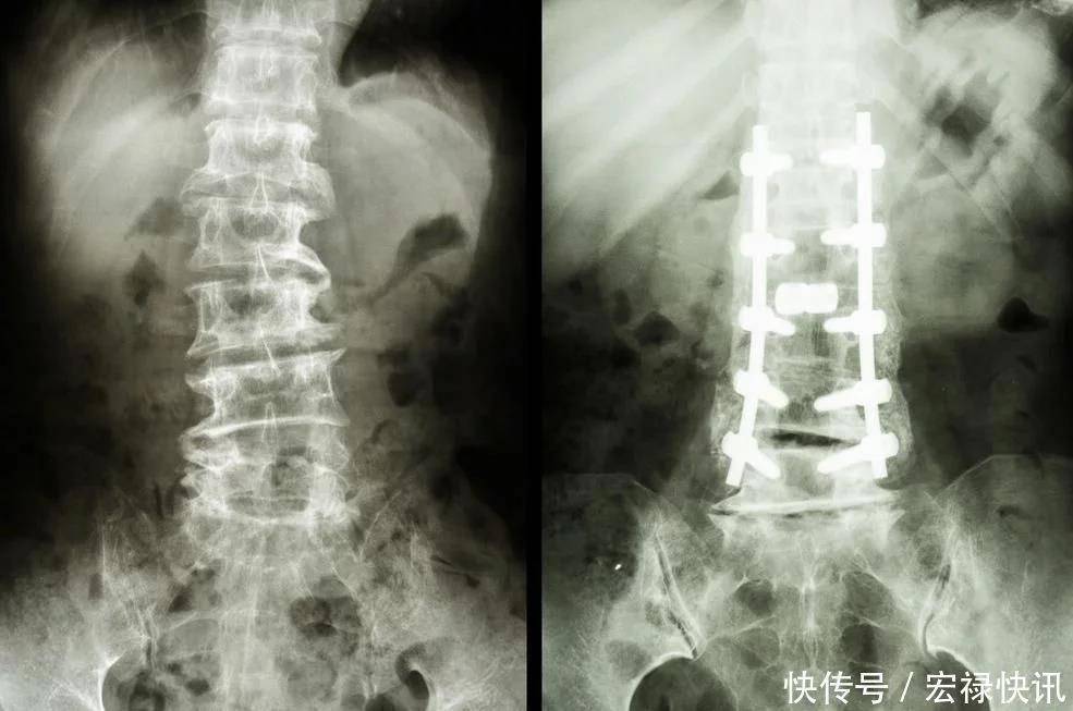 原创            如何有效地预防骨质疏松